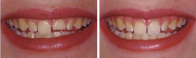 Before and After Dental Bonding Photo