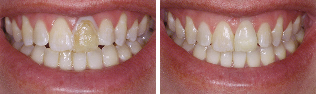 Before and After Porcelain Crowns Photo