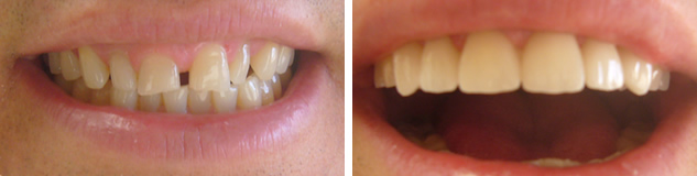 Before and After Veneers #3 Photo