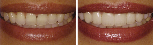 Before and After Veneers #1 Photo